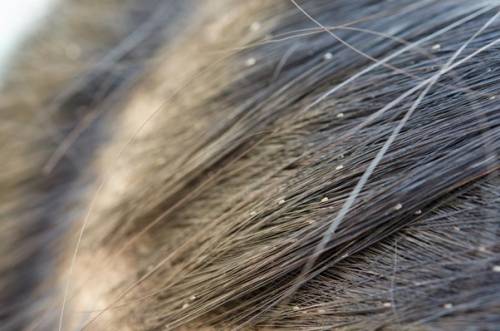Lice and Dice: A guide to treating dandruff and lice