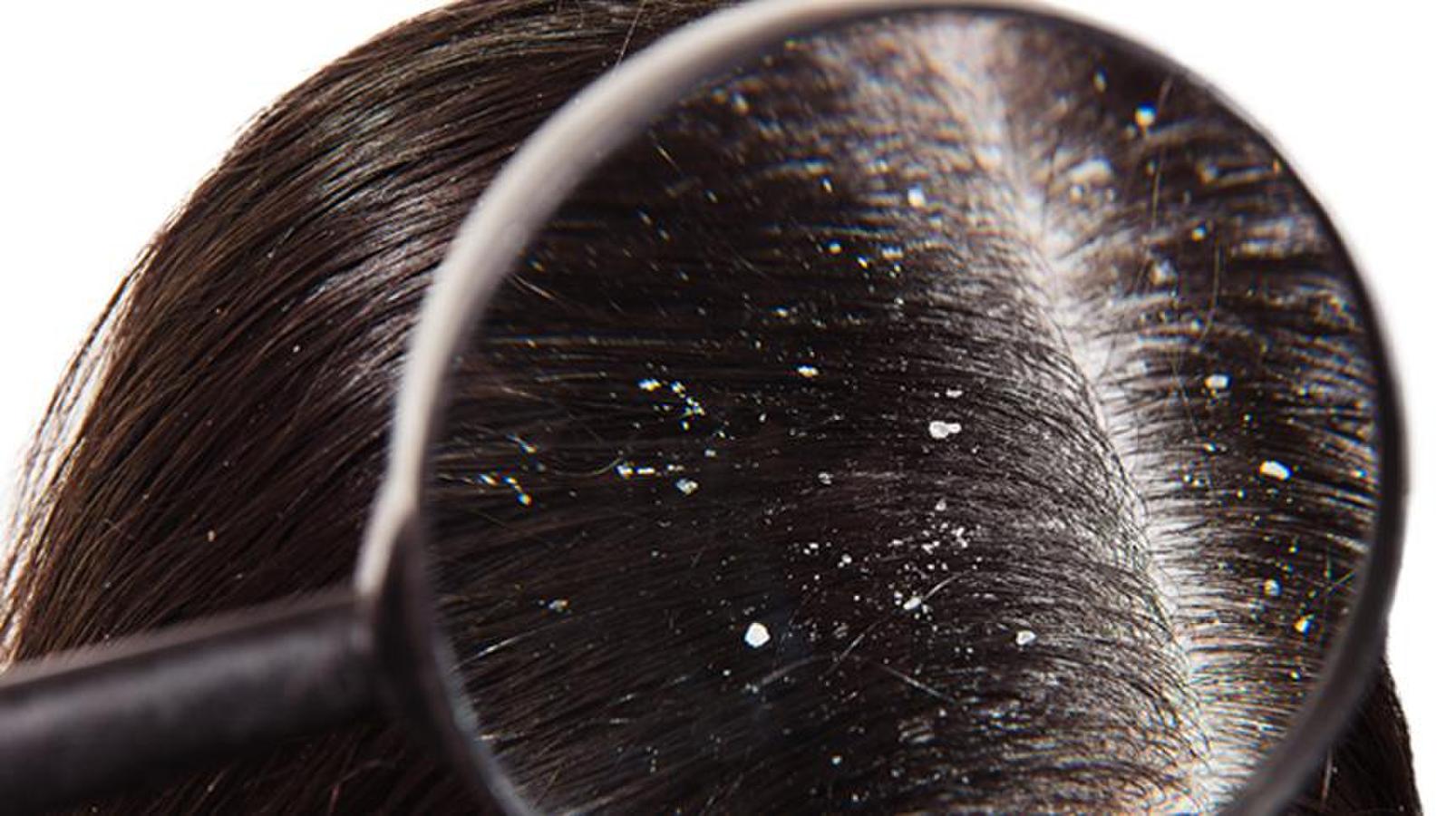 Lice and Dice: A guide to treating dandruff and lice