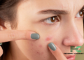 The Secret Message Behind Your Breakouts