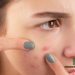 The Secret Message Behind Your Breakouts