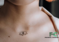 Goiter 101: Causes, Symptoms, and Treatment