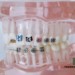 Crooked Teeth Don’t Have to Stay That Way! Your Guide to Fixing Crowding