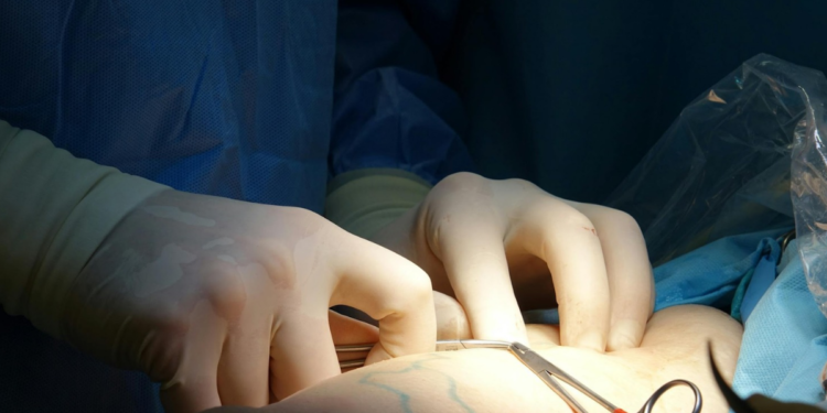 After BBL Surgery: How To Handle And Avoid Fat Necrosis