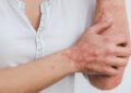 Psoriasis: What You Need to Know About This Skin Condition