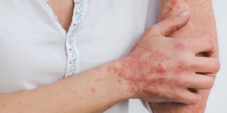 Psoriasis: What You Need to Know About This Skin Condition