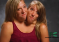 Abby and Brittany Hensel’s Extraordinary Lives As Conjoined Twins