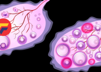 PCOS on the Rise: What’s Causing This Increase in Women?