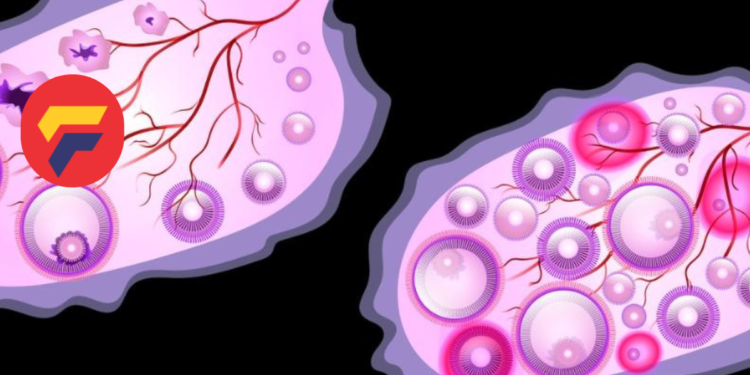PCOS on the Rise: What’s Causing This Increase in Women?