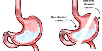 Are You Considering Gastric Sleeve Surgery For Weight Loss? Learn The Pros & Cons Before You Commit
