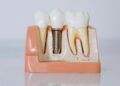 How to Banish Back-Teeth Plaque