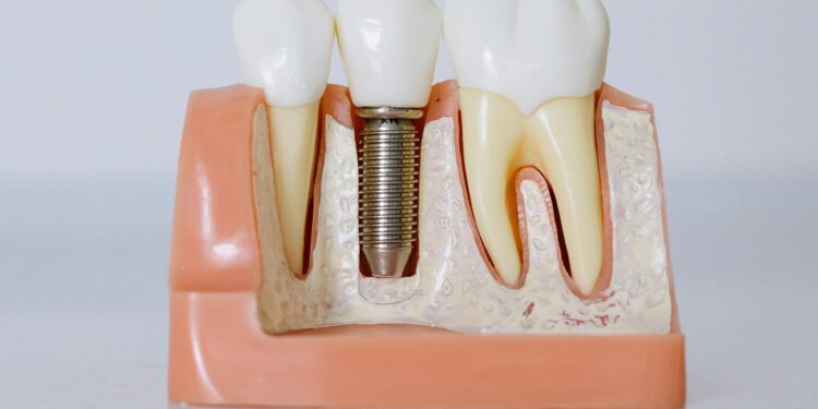 How to Banish Back-Teeth Plaque