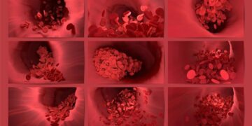 Stroke vs. Mini Stroke: What’s The Difference?