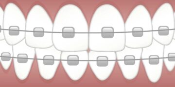 What Is The Difference Between Braces And Retainers?