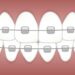 What Is The Difference Between Braces And Retainers?