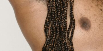 What Causes Hidradenitis Suppurativa (HS) To Smell Bad During Flare-ups?