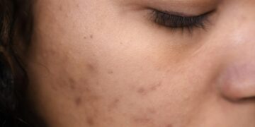 Period Breakouts: Ways To Reduce Acne Breakouts During Your Period