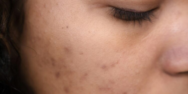 Period Breakouts: Ways To Reduce Acne Breakouts During Your Period