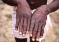 New Deadly Mpox Strain Emerges In DR Congo