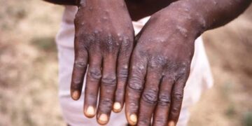 New Deadly Mpox Strain Emerges In DR Congo