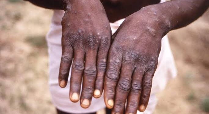 New Deadly Mpox Strain Emerges In DR Congo