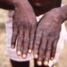 New Deadly Mpox Strain Emerges In DR Congo