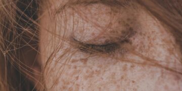 LEOPARD Syndrome (NSML): Symptoms, Causes, and Treatment