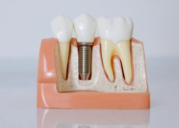 Top 4 Ways to Whiten Yellow Teeth & Restore Translucency