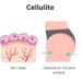 How to Deal with Cellulite: Causes, Treatments & Prevention Tips