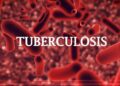 Nigeria Requests a $25 million Private Sector Investment to Fight Tuberculosis