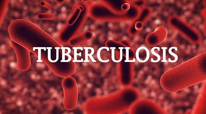 Nigeria Requests a $25 million Private Sector Investment to Fight Tuberculosis