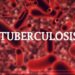 Nigeria Requests a $25 million Private Sector Investment to Fight Tuberculosis