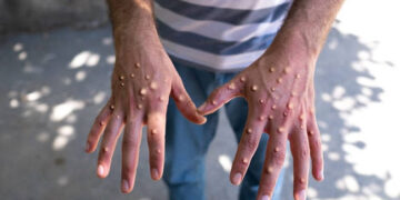 Burundi: Health Ministry Reports 3 Mpox Cases