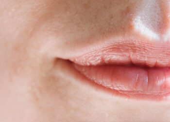 Can You Get Rid of Lip Fillers Naturally? Here’s What You Need to Know