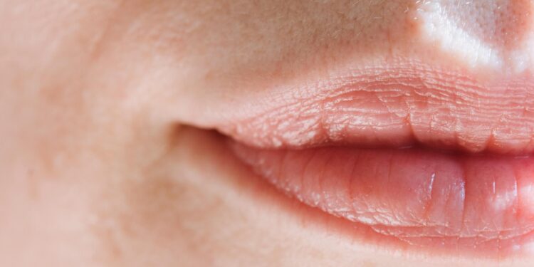 Can You Get Rid of Lip Fillers Naturally? Here’s What You Need to Know