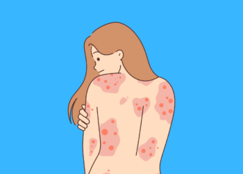 Living with Lupus: Treatment, and Coping Strategies