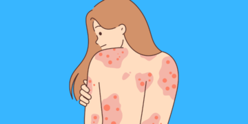 Living with Lupus: Treatment, and Coping Strategies