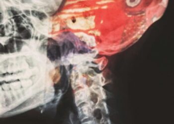 CSF Cerebrospinal Fluid: The Liquid Cushioning Your Brain