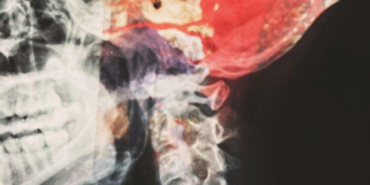 CSF Cerebrospinal Fluid: The Liquid Cushioning Your Brain