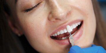 To Get Veneers or Not? What You Need to Know Before Making a Choice