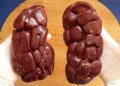 Kidney Stones: What Are They and Why Do They Form?