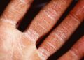 Dermatitis: Symptoms and Causes