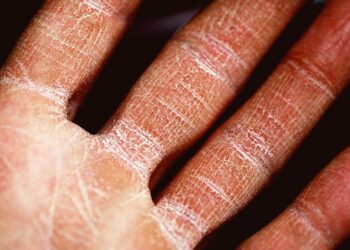 Dermatitis: Symptoms and Causes