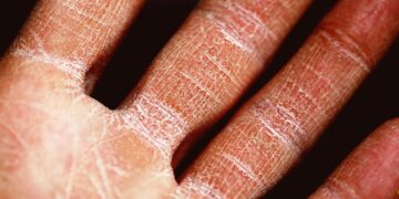 Dermatitis: Symptoms and Causes