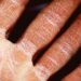 Dermatitis: Symptoms and Causes