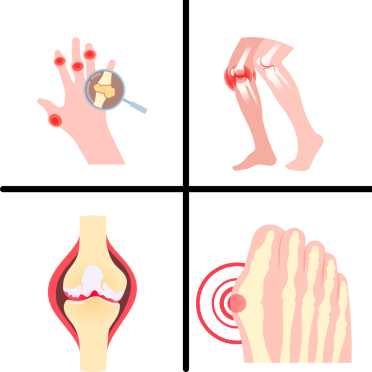 How To Conquer Gout: Effective Treatment and Prevention Tips