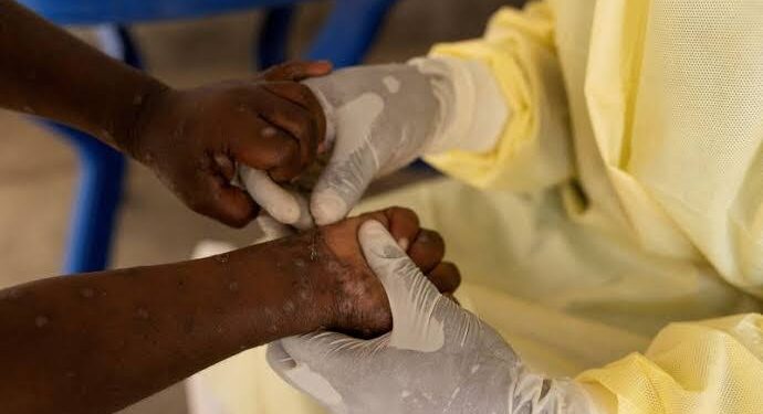 Lagos Begins Mpox Campaign Over Fear of the New Version