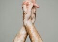 Shocking Rise in Vitiligo: Why is Vitiligo on the Rise? Are You at Risk?