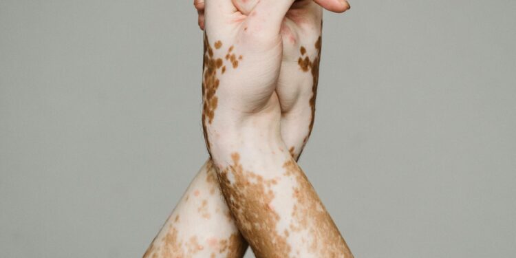 Shocking Rise in Vitiligo: Why is Vitiligo on the Rise? Are You at Risk?