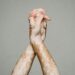 Shocking Rise in Vitiligo: Why is Vitiligo on the Rise? Are You at Risk?