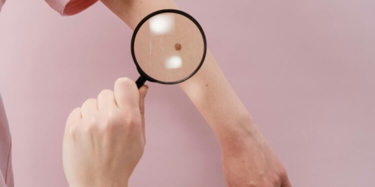 Shingles (Herpes Zoster): Treatment and Prevention